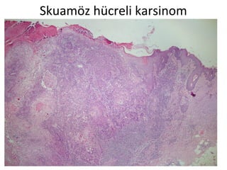 Skuamöz hücreli karsinom
 