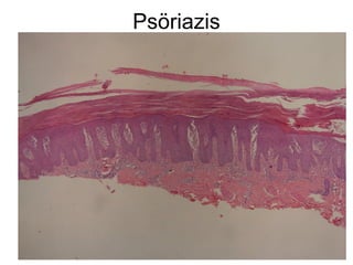 Psöriazis
 