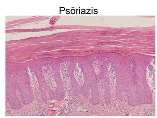 Psöriazis
 
