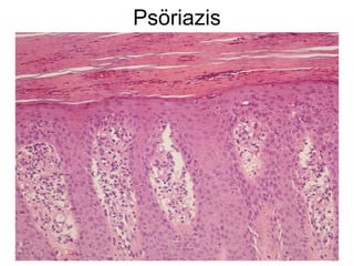 Psöriazis
 