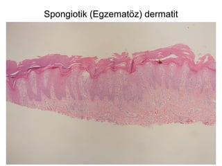 Spongiotik (Egzematöz) dermatit
 