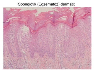 Spongiotik (Egzematöz) dermatit
 
