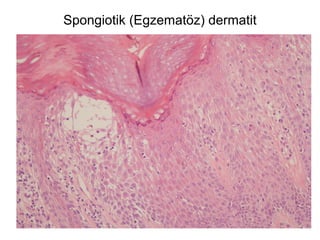 Spongiotik (Egzematöz) dermatit
 