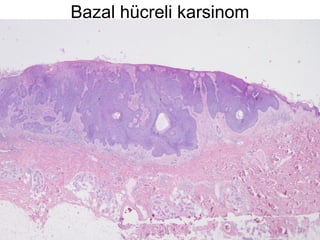 Bazal hücreli karsinom
 