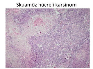 Skuamöz hücreli karsinom
 
