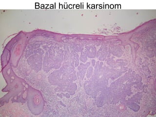 Bazal hücreli karsinom
 
