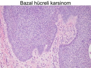 Bazal hücreli karsinom
 