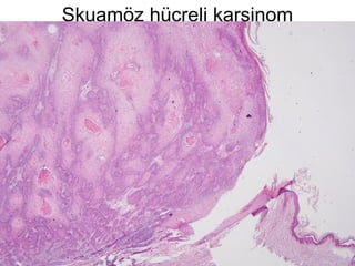 Skuamöz hücreli karsinom
 