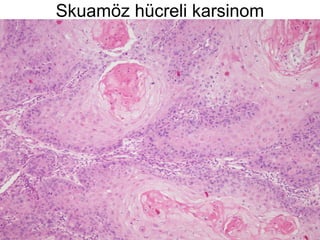 Skuamöz hücreli karsinom
 