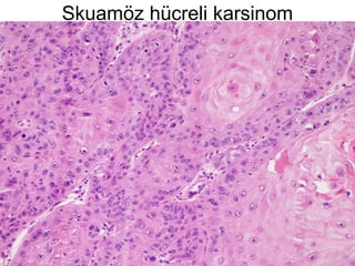 Skuamöz hücreli karsinom
 