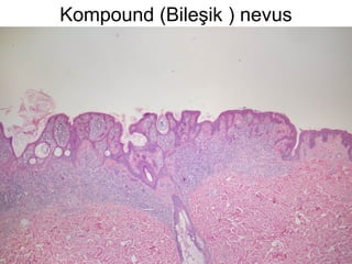 Kompound (Bileşik ) nevus
 