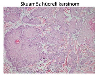 Skuamöz hücreli karsinom
 