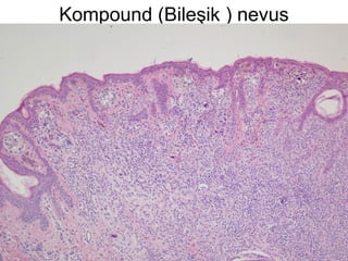 Kompound (Bileşik ) nevus
 