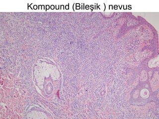 Kompound (Bileşik ) nevus
 