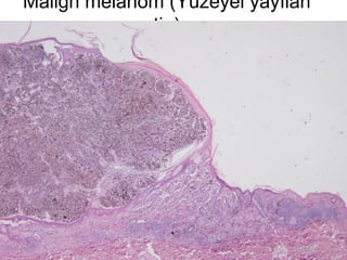 Malign melanom (Yüzeyel yayılan
tip)
 