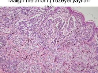 Malign melanom (Yüzeyel yayılan
tip)
 