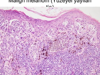 Malign melanom (Yüzeyel yayılan
tip)
 