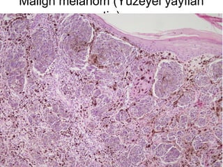 Malign melanom (Yüzeyel yayılan
tip)
 