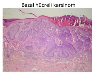 Bazal hücreli karsinom
 