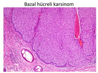 Bazal hücreli karsinom
 