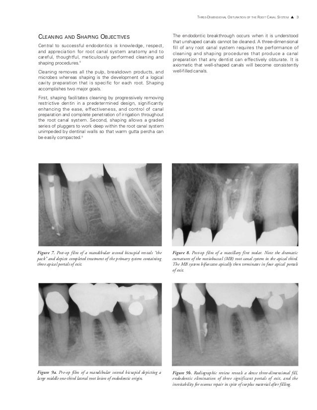 THREEDIMENSIONAL OBTURATION OF THE ROOT CANAL SYSTEM* by Clifford J.…