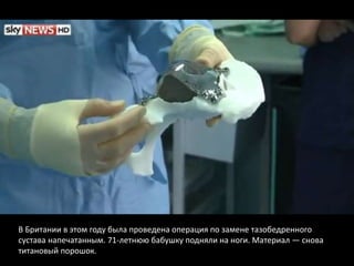 В Британии в этом году была проведена операция по замене тазобедренного
сустава напечатанным. 71-летнюю бабушку подняли на ноги. Материал — снова
титановый порошок.
 