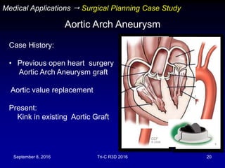 September 8, 2016 Tri-C R3D 2016 20
Medical Applications  Surgical Planning Case Study
Aortic Arch Aneurysm
Case History:
• Previous open heart surgery
Aortic Arch Aneurysm graft
Aortic value replacement
Present:
Kink in existing Aortic Graft
 