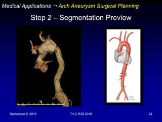 September 8, 2016 Tri-C R3D 2016 24
Step 2 – Segmentation Preview
Medical Applications  Arch Aneurysm Surgical Planning
 