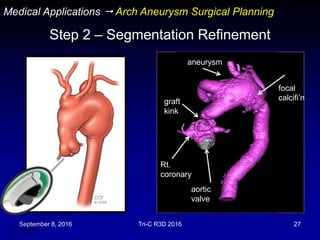 September 8, 2016 Tri-C R3D 2016 27
Step 2 – Segmentation Refinement
Medical Applications  Arch Aneurysm Surgical Planning
aortic
valve
graft
kink
aneurysm
Rt.
coronary
focal
calcifi’n
 