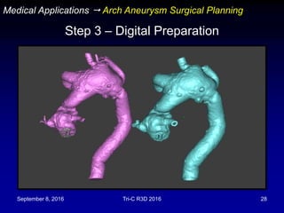 September 8, 2016 Tri-C R3D 2016 28
Step 3 – Digital Preparation
Medical Applications  Arch Aneurysm Surgical Planning
 