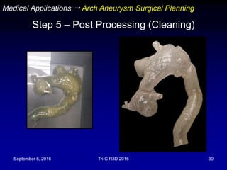 September 8, 2016 Tri-C R3D 2016 30
Step 5 – Post Processing (Cleaning)
Medical Applications  Arch Aneurysm Surgical Planning
 