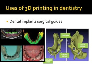 3D printing in dentistry | PPTX