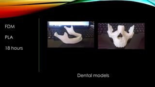 FDM
PLA
18 hours
Dental models
 