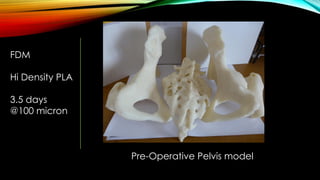 FDM
Hi Density PLA
3.5 days
@100 micron
Pre-Operative Pelvis model
 