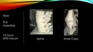 FDM
PLA
Assembly
12 hours
@90 micron Spine Knee Caps
 