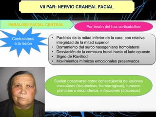 VII PAR: NERVIO CRANEAL FACIAL
PARALISIS FACIAL CENTRAL
Por lesión del haz corticobulbar
• Parálisis de la mitad inferior de la cara, con relativa
integridad de la mitad superior
• Borramiento del surco nasogeniano homolateral
• Desviación de la comisura bucal hacia el lado opuesto
• Signo de Ravilliod
• Movimientos mímicos emocionales preservados
Contralateral
a la lesión
Suelen observarse como consecuencia de lesiones
vasculares (isquémicas, hemorrágicas), tumores
primarios o secundarios, infecciones (abscesos)
 