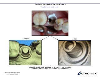 DIGITAL IMPRESSION + G-CUFF™
Implant core is totally visible
CERE C
BY E4DBY CEREC
PREDICTABLE AND ACCURATE G-CUFF™ IMPRESSION
LEADS TO THE HIGH PRECISION RESTORATON
please consult the user manual
www.stomatotech.com
 
