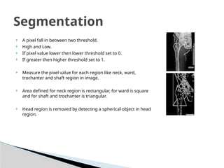  A pixel fall in between two threshold.
 High and Low.
 If pixel value lower then lower threshold set to 0.
 If greater then higher threshold set to 1.
 Measure the pixel value for each region like neck, ward,
trochanter and shaft region in image.
 Area defined for neck region is rectangular, for ward is square
and for shaft and trochanter is triangular.
 Head region is removed by detecting a spherical object in head
region.
Segmentation
 