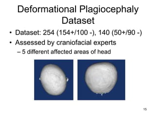 15
Deformational Plagiocephaly
Dataset
• Dataset: 254 (154+/100 -), 140 (50+/90 -)
• Assessed by craniofacial experts
– 5 ...