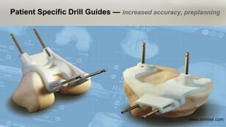 Patient Specific Drill Guides — increased accuracy, preplanning

www.zimmer.com

 