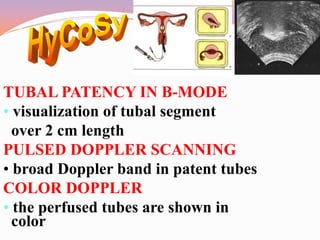 Tube Patency 3 D Ultrasound in reproductive medicine | PDF