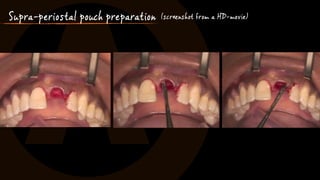 Supra-periostal pouch preparation (screenshot from a HD-movie)
 