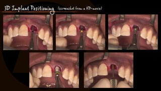 3D Implant Positioning (screenshot from a HD-movie)
 