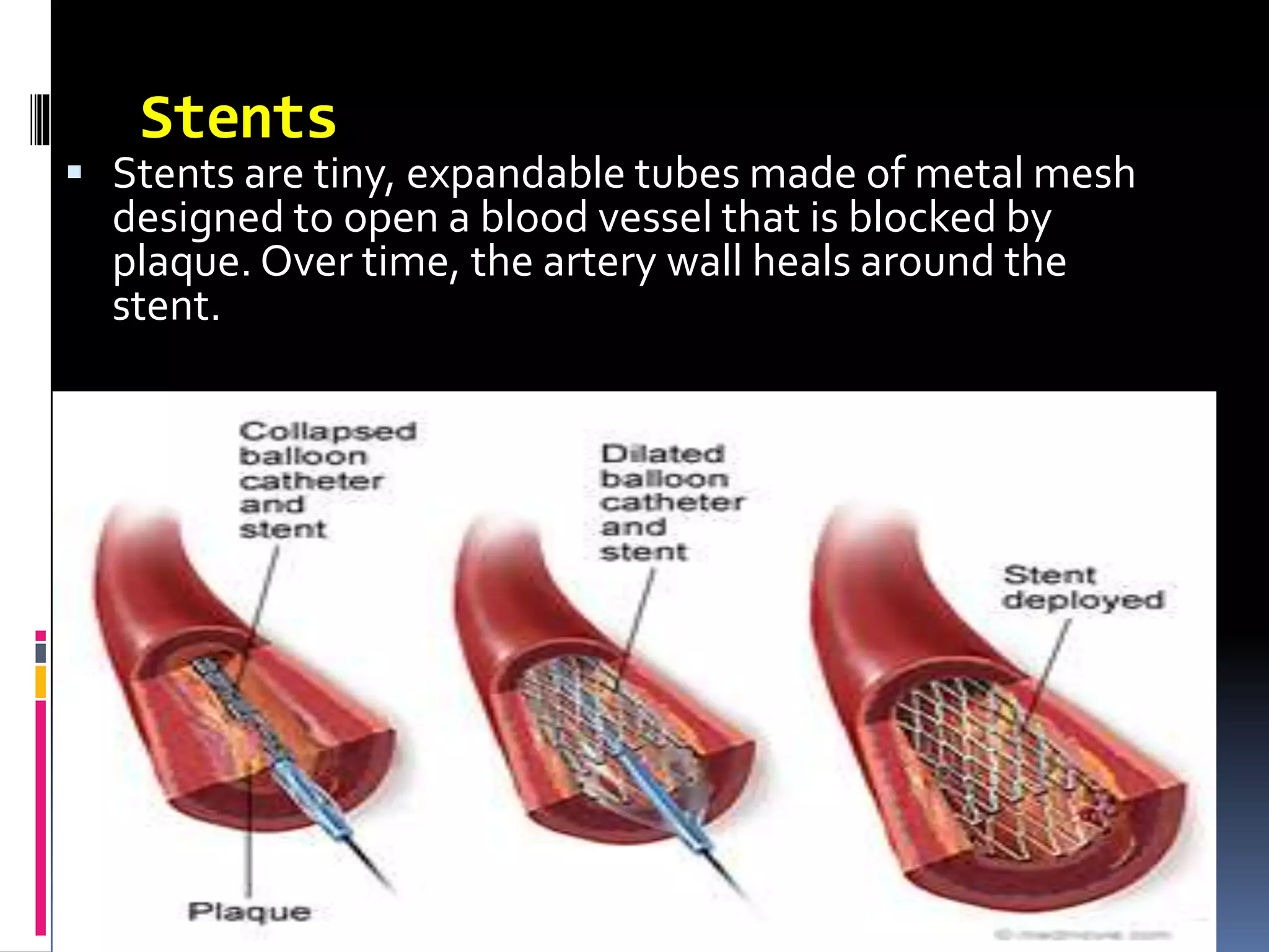 Stents Rinones Stents3 | PPTX