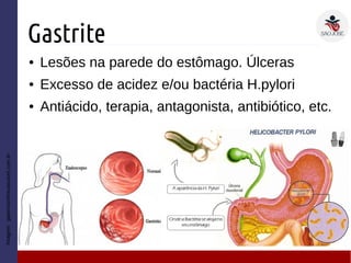 Gastrite
● Lesões na parede do estômago. Úlceras
● Excesso de acidez e/ou bactéria H.pylori
● Antiácido, terapia, antagonista, antibiótico, etc.
Imagem:gastrocentrocascavel.com.br
 