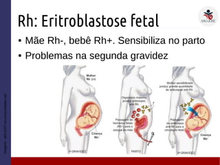 Rh: Eritroblastose fetal
● Mãe Rh-, bebê Rh+. Sensibiliza no parto
● Problemas na segunda gravidez
Imagem:stef-0107.no.comunidades.net
 
