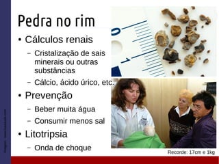 Pedra no rim
Imagem:www.tuasaude.com
Recorde: 17cm e 1kg
● Cálculos renais
– Cristalização de sais
minerais ou outras
substâncias
– Cálcio, ácido úrico, etc.
● Prevenção
– Beber muita água
– Consumir menos sal
● Litotripsia
– Onda de choque
 