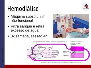 Hemodiálise
● Máquina substitui rim
não-funcional
● Filtra sangue e retira
excesso de água
● 3x semana, sessão 4h
Imagem:www.sbn.org.br
 