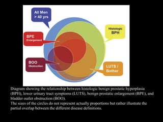 Luts Boo Prostate tumor cancer oncology ppt everything | PDF