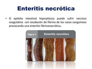 Enteritis necrótica
• El epitelio intestinal hiperplásico puede sufrir necrosis
coagulativa con exudación de fibrina de los vasos sanguíneos
provocando una enteritis fibrinonecrótica.
 